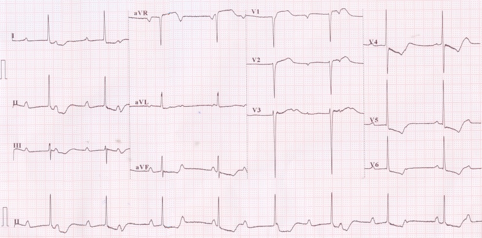 #ECGclass Case 2&19 (1)