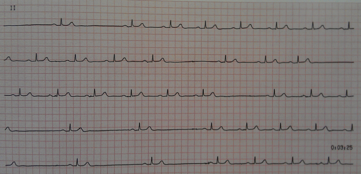 2ECG
