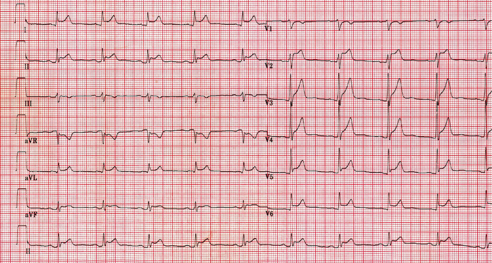 ATclass2i#ECGclass