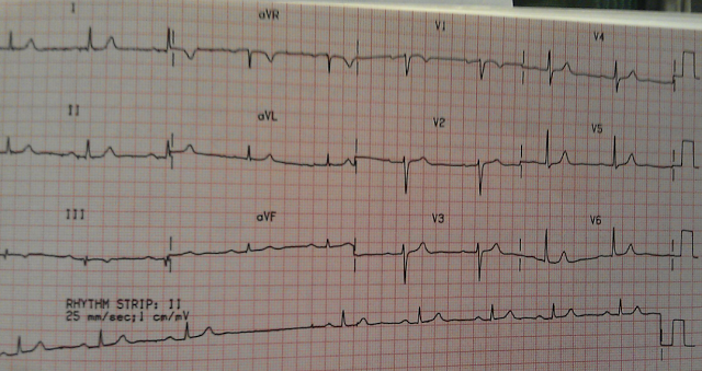 ECG