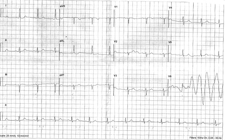 #ecgclass case23