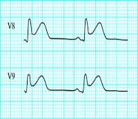 00ECG