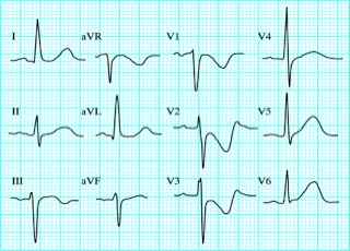 ECG00