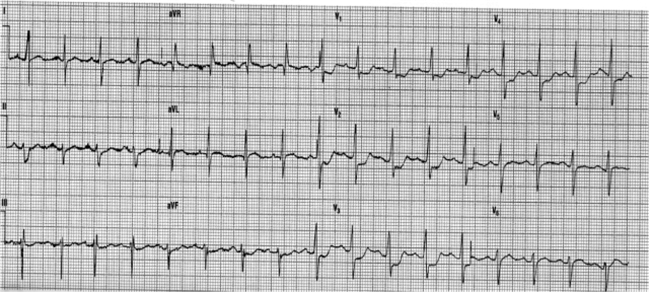 ECGclass