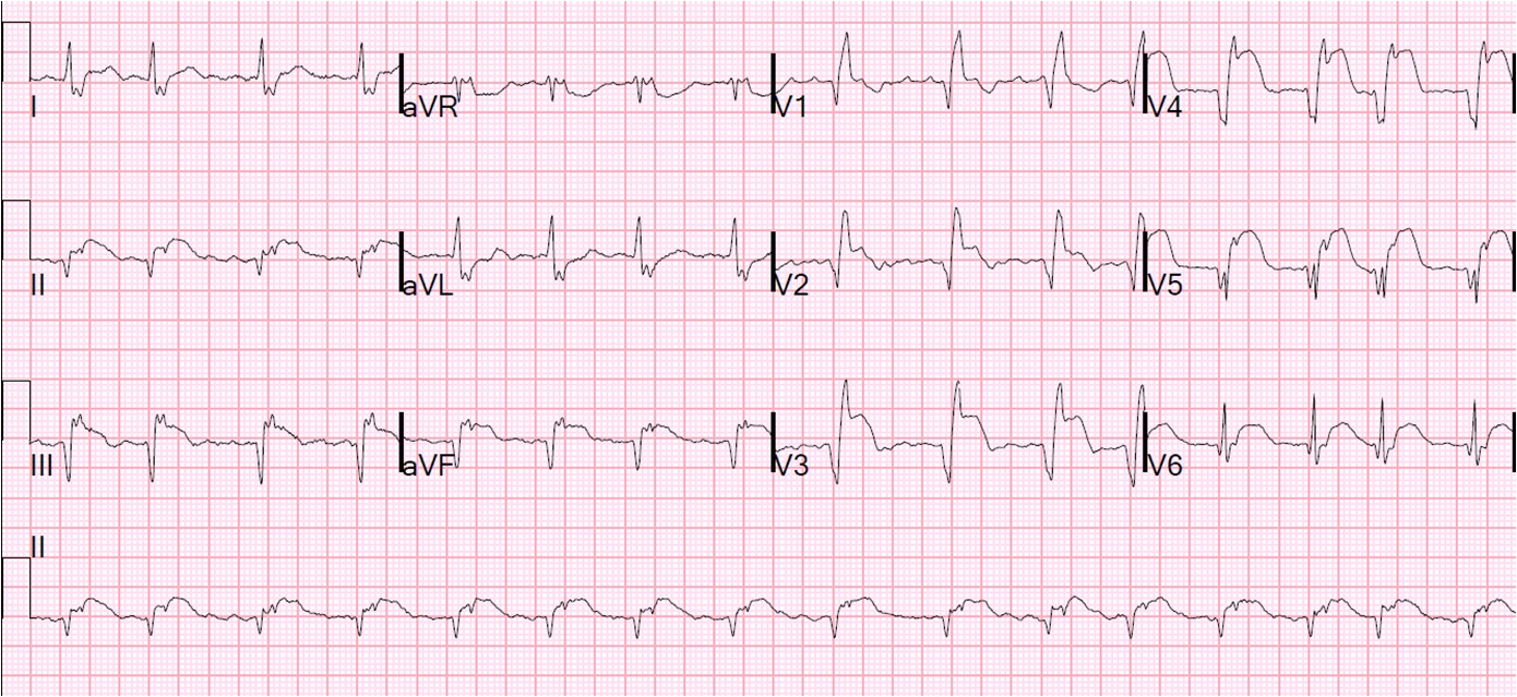 First ECG 4 days after onset of pain