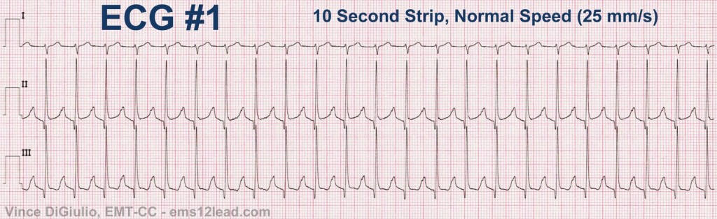 ECG113